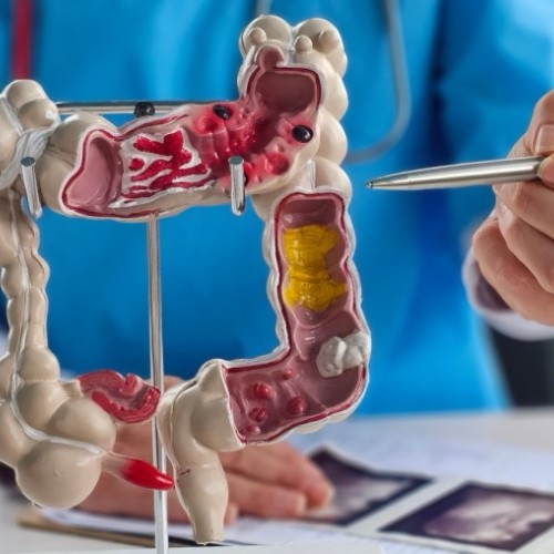 Mars Bleu lève les tabous sur le cancer colorectal à Paris